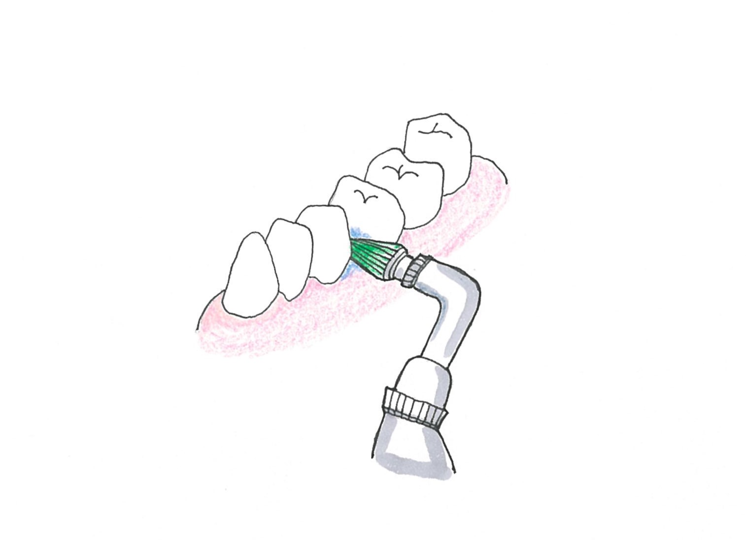 歯間清掃
