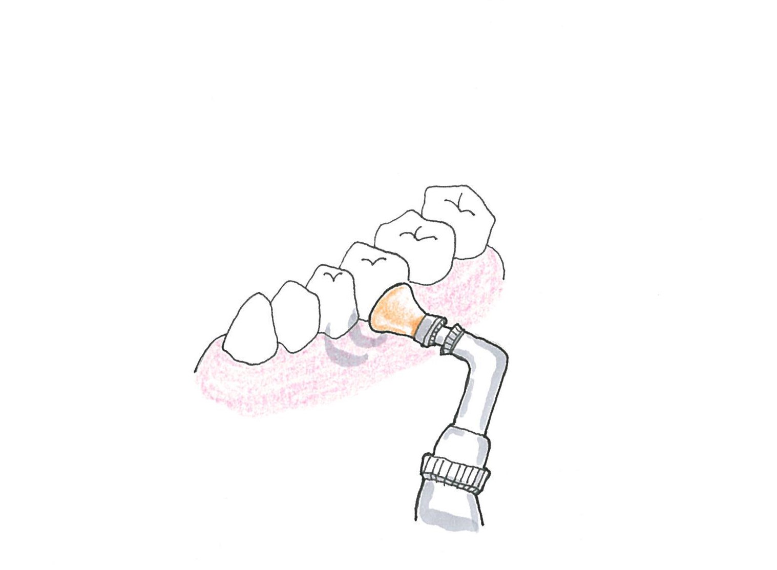 歯面清掃
